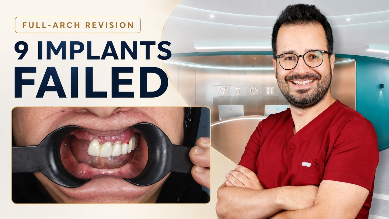 9 Failed Dental Implants Revised With All-on-4 & Bone Augmentation