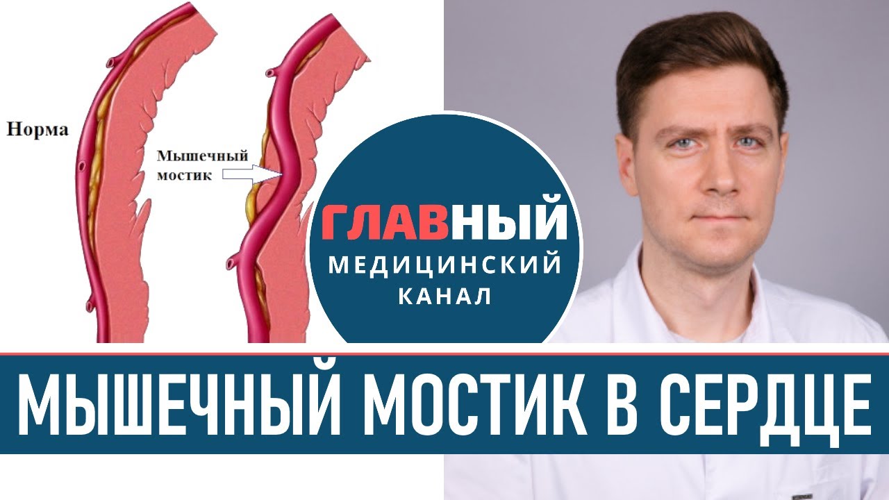 Боли в СЕРДЦЕ, стенокардия. Мышечный мостик в коронарных артериях ...
