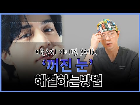 Fixing multiple folds and hollow upper eyelids
