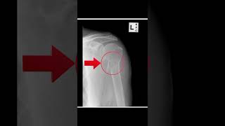 Do You Recognise This Shoulder Fracture? | OSCE