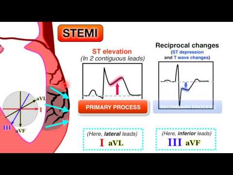 تصویری: کدام تغییر ECG برای ایسکمی قلبی مشخص است؟
