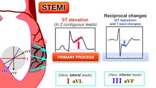 Ischemia 6/7 - STEMI on ECG