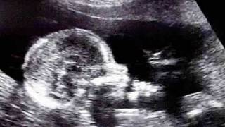 Fetal Development Week 17 (Pregnancy Health Guru) Fetal Development Week 17 (Pregnancy Health Guru)