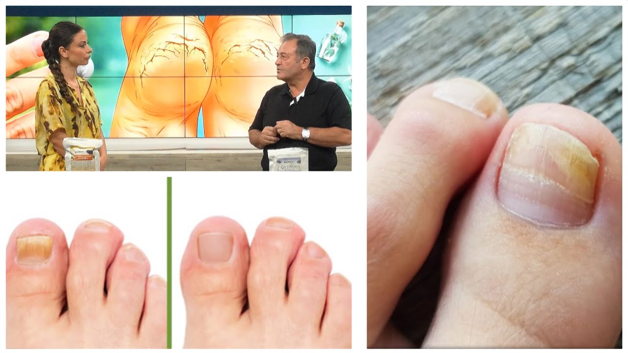 Thonj të verdhë e me myk? Ja si ta ZHDUKËSH mykun në pak ditë