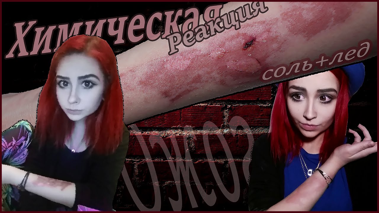 ХИМИЧЕСКАЯ РЕАКЦИЯ. ОЖОГ. НЕ ПОВТОРЯТЬ.