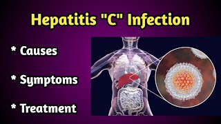 Hepatitis C virus Infection Causes, Symptoms and Treatment