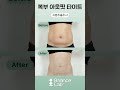 복부 아웃핏 타이트❤️️ #복부지방흡입 #지방추출주사 #밸런스랩성형외과