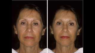 Shocking Before & After Photos of Cosmetic Dermatology