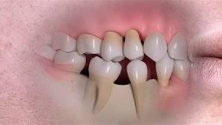 Following tooth loss - Jaw bone deterioration