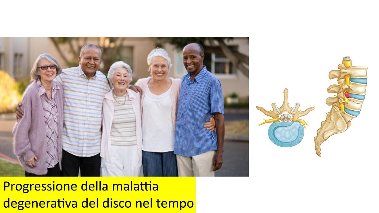 Callas Malattia Degenerativa Progressione della malattia degenerativa del disco nel tempo - YouTube