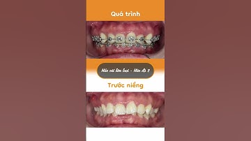 Hành trình LỘT XÁC nhờ niềng răng của Bích Phương