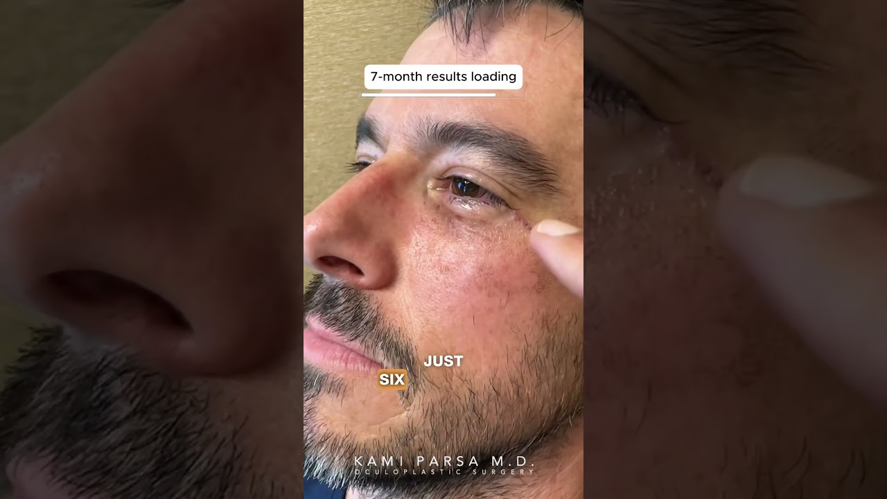 Healed Male Patient 7 Months After Trifecta Lift with Dr. Kami Parsa | Beverly Hills, CA