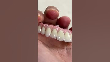 6-Implant Zirconia Arch