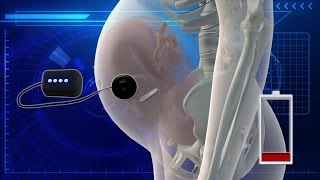 Fetal pacemaker to begin human trials