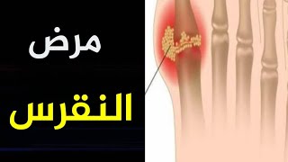 علاج النقرس بدون أدوية