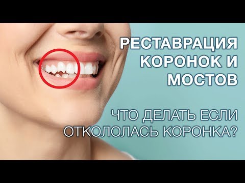 Реставрация керамической коронки при сколе.