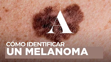 ¿Cómo describir un melanoma?