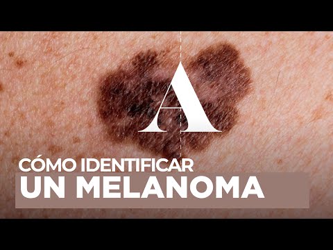 Melanoma: qué es y cómo identificarlo