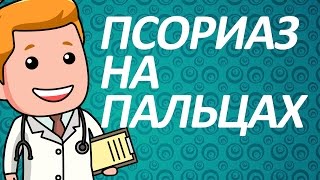 Псориаз на пальцах рук. Как лечить псориаз на руках? Псориаз на пальцах рук. Как лечить псориаз на руках?