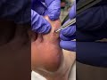 Expert callus  corn removal by top australian podiatrist  say goodbye to hard skin