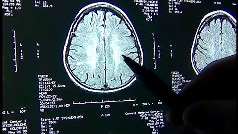 Boston University study suggests CTE diagnosis in living patients possible