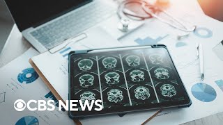 How new Alzheimer's drug Leqembi works, risks and who might benefit