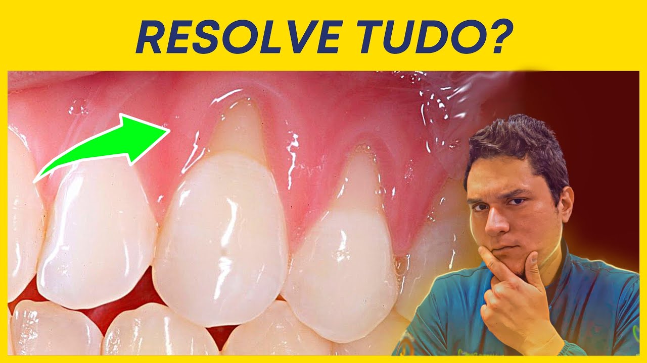 COMO TRATAR RETRAÇÃO DE GENGIVA?