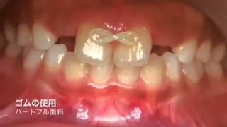 小児矯正 前歯が離れている症例正中離開 東京都 三鷹ハートフル矯正歯科医院 Youtube