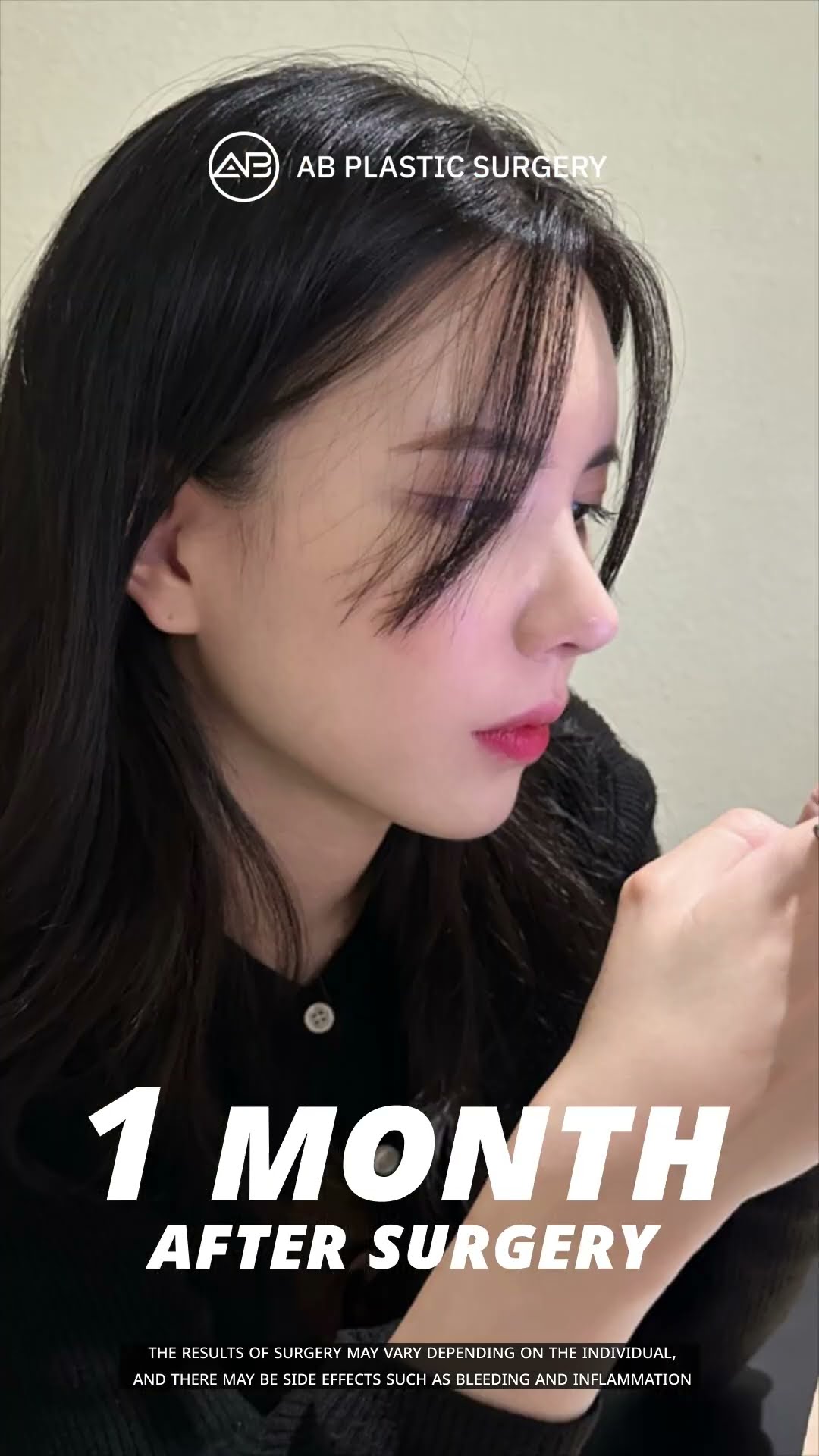 [Plastic surgery in Korea] Non-Implant Rhinoplasty + Hump Nose