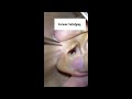 Best pimple popping