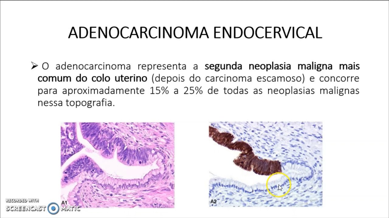 Eco Glandular Endocervical Presente - BRAINCP