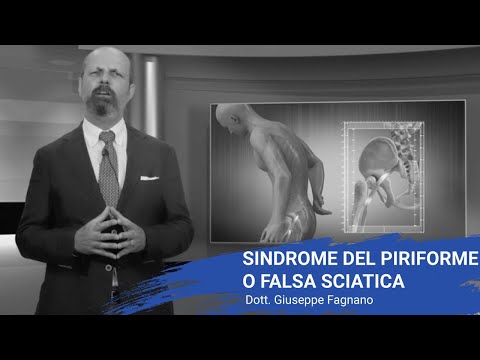 Sindrome del piriforme o falsa sciatica