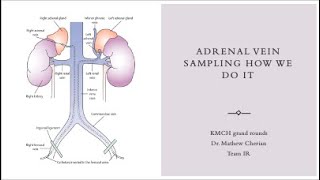 Adrenal vein sampling