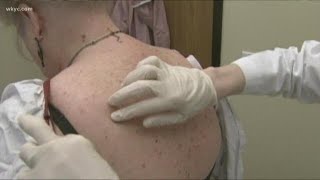 Melanoma Monday: Life-saving tips to avoid skin cancer
