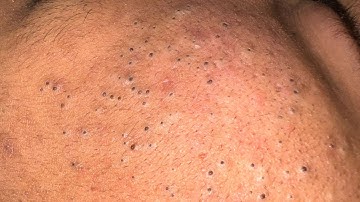 Satisfying Pimple Extraction — Deep Facial Cleansing and Skincare Routine