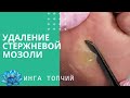 Стержневая мозоль. Аппаратный педикюр.