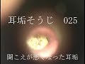 耳垢そうじ/聞こえが悪くなった耳垢/025