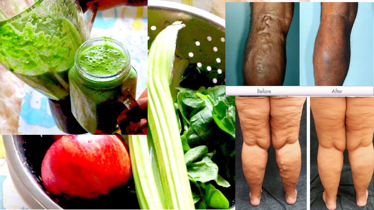 GET RID OF VARICOSE VEINS,SPIDER VEINS WITH THIS SIMPLE DRINK YouTube
