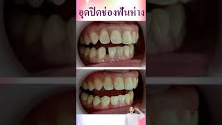 รีวิวอุดฟันห่าง