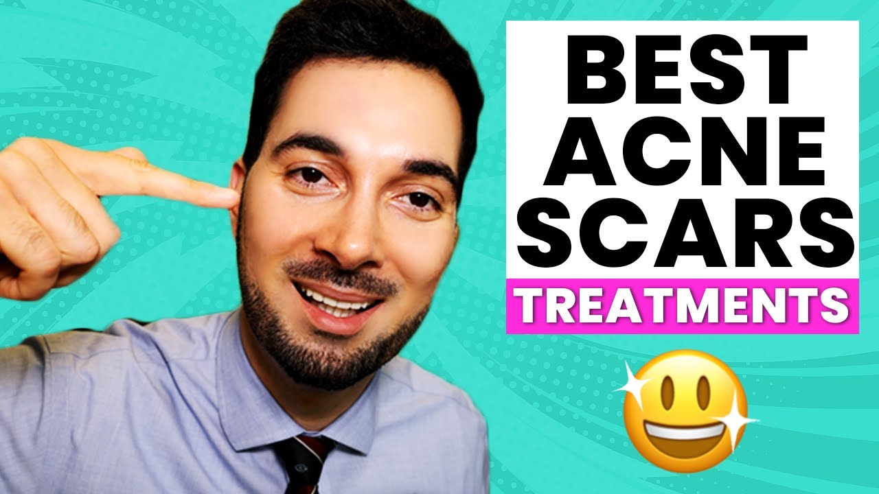 How To Get Rid Of Acne Scars Treatment and Removal