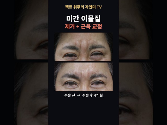 미간 이물질 주사의 위험성, 실제 증례#미간주름 #미간이물질 #이물질제거 #자연미TV