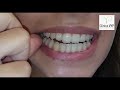 Colocación, desinserción e higiene de los alineadores Invisalign. Dr. Samuel Verdugo. Clínica VYP.