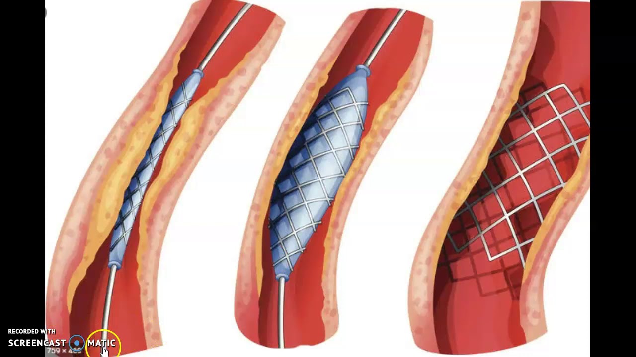 Развития тромбов. Эндоваскулярная тромбэктомия. Ангиопластика почечных артерий. Ангиопластика и тромболизис.