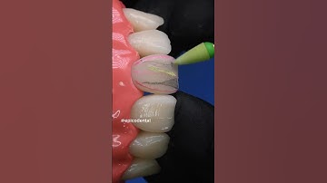 Composite veneers. Direct composite restoration front teeth. Veneers #dentist #dentalstudent