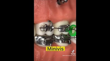 Đừng xem video này nếu bạn vẫn nghĩ cắm vít sẽ đau!