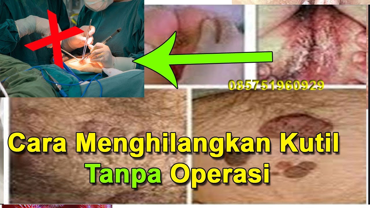 Cara Menghilangkan Kutil Di Kamaluan Tanpa Operasi Kutil Kelamin 