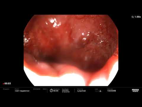 Mallory-Weiss syndrome. Endoscopic Treatment Bleeding. Forrest IB. С-м Мелори-Вейса, гемостаз