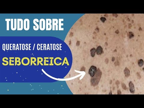 Vídeo: Queratose Seborréica X Melanoma: Conheça Os Fatos