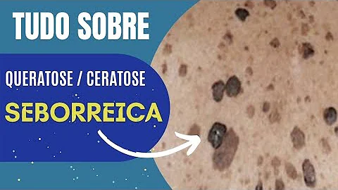 O que causa a queratose seborreica?