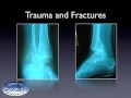 Treatment of Ankle Fractures